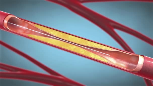 Стентовая имплантация для поддержания циркуляции крови в кровеносных сосудах во время ангиопластики - 3d иллюстрация