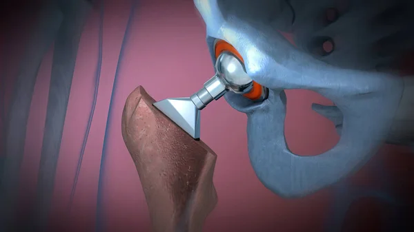 Działanie Implantu Stawu Biodrowego Lub Protezy Stawu Biodrowego Widok Ilustracja — Zdjęcie stockowe