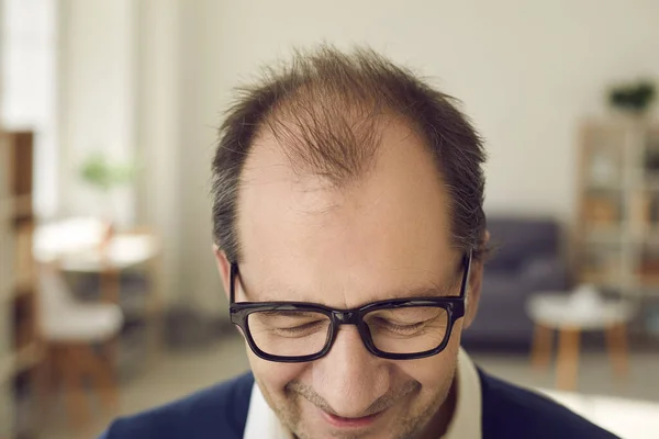 Nahaufnahme des Kopfes eines fröhlich kahlköpfigen reifen Mannes, der eine Behandlung gegen Haarausfall braucht — Stockfoto