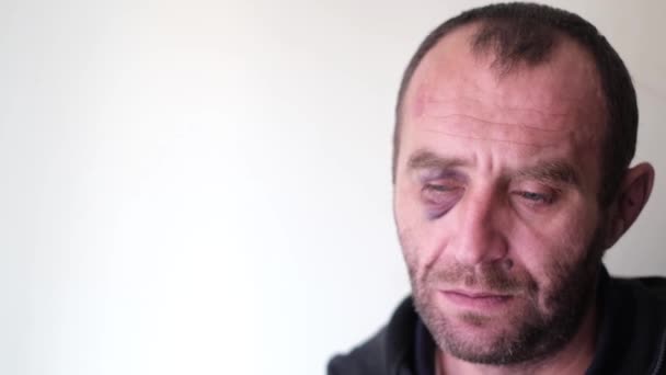 Uomo triste con un livido sotto l'occhio. — Video Stock