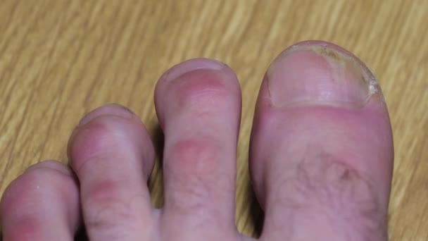 Онихолиз: отслоение ногтя от ногтевого ложа. Грибковая инфекция ногтей. — стоковое видео