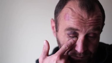 Alkolik bir adam göz altındaki hematom kremini kayganlaştırır.. 
