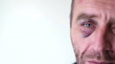 Alkol bağımlısı bir adamın yüzünde hematom var. Bir alkoliğin yüzü 