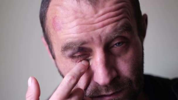 O homem tem uma nódoa negra debaixo do olho, manchada com creme de hematoma no rosto — Vídeo de Stock