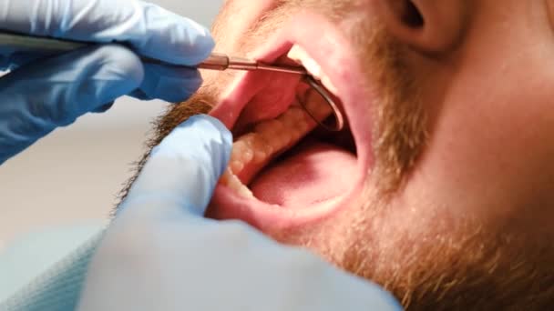 Close Oral Cavity Dental Treatment Examination Dental Mirror Close Oral — Video Stock