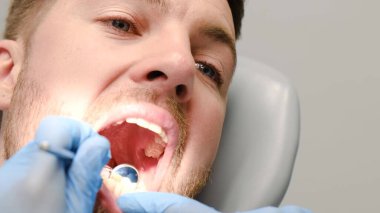 Close-up of a young patients oral treatment during dental treatment. Examination with a dental mirror