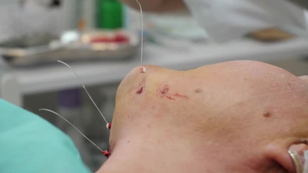Il chirurgo taglia i fili dopo la chirurgia plastica sul viso dei pazienti. — Video Stock