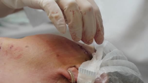 Le chirurgien coupe les fils après la chirurgie plastique sur le visage des patients. — Video