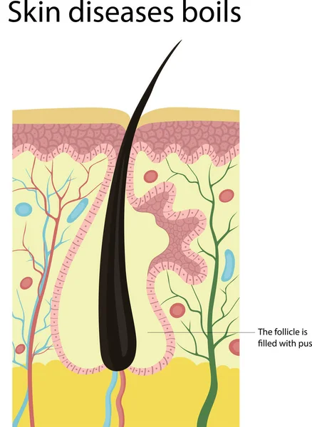 Deri kürkçüsü hastalığının vektör çizimi. Folikül irinle dolu. Diyagram Furya amca.