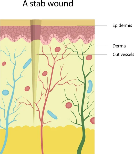 Vector Illustration Structure Stab Wound Cut Vessels — Vector de stock