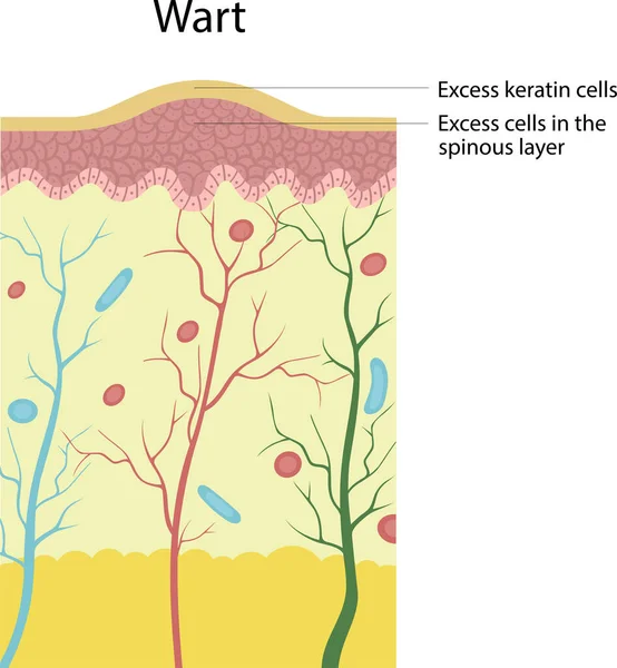 Excess Keratin Cells Excess Cells Spinous Layer — Stock vektor