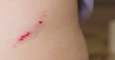 Kadınlar yaralarına antiseptik sprey sıkarlar. Yarayı tedavi et. İlk Yardım