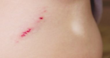 Kadınlar yaralarına antiseptik sprey sıkarlar. Yarayı tedavi et. İlk Yardım