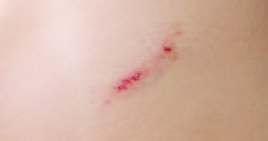 Kadınlar yaralarına antiseptik sprey sıkarlar. Yarayı tedavi et. İlk Yardım