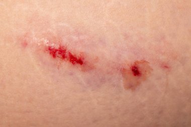 Çürük. Büyük çürük. Enjeksiyon çürükler. Doktor ve hasta. Bruised yaralanma yara ve cilt bereli.
