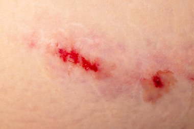 Çürük. Büyük çürük. Enjeksiyon çürükler. Doktor ve hasta. Bruised yaralanma yara ve cilt bereli.