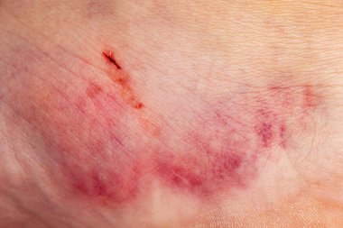 Çürük. Büyük çürük. Enjeksiyon çürükler. Doktor ve hasta. Bruised yaralanma yara ve cilt bereli.