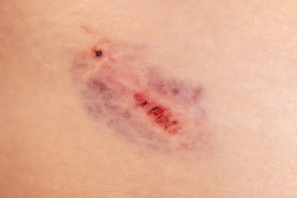 Closeup Bruise Wounded Woman Leg Skin Domestic Violence Large Bruise — Fotografia de Stock