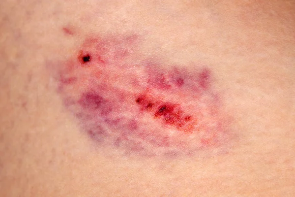 Closeup Bruise Wounded Woman Leg Skin Domestic Violence Large Bruise — Stock Photo, Image