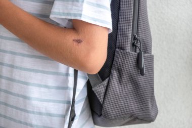 Çocuk elinde iyileşme yarası. Genç çocuğun dirsek derisinde derin çizikler var. Yaralar, çizikler, kabuklu sıyrık, yara izi, yaraların tedavisi, tıbbi bakım, sağlık riski.