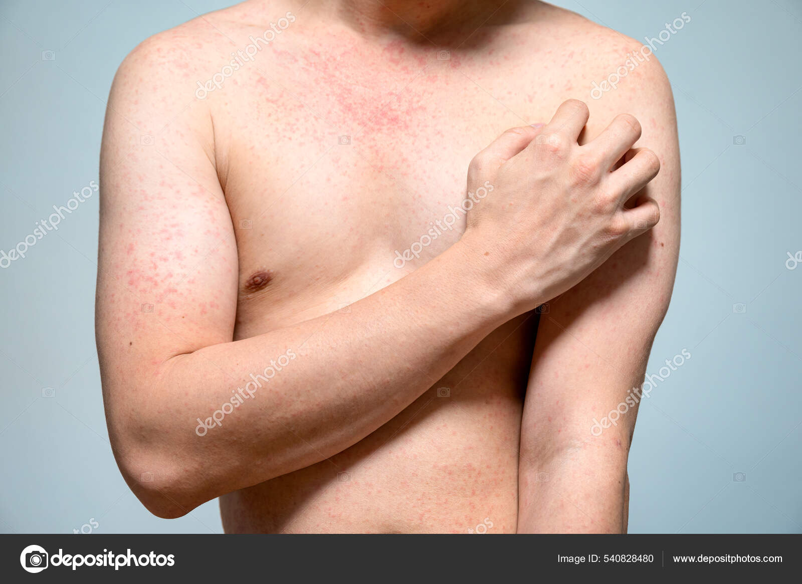 Dermatitis Rash Viral Disease Immunodeficiency Body Young Adult Asian