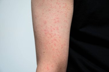 Dermatitis rash viral disease with immunodeficiency on arm of young adult asian, scratch with itch, Measles Virus, Viral Exanthem