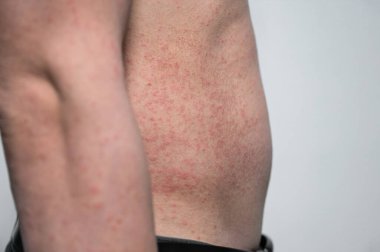 Dermatitis rash viral disease with immunodeficiency on body of young adult asian, scratch with itch, Measles Virus, Viral Exanthem clipart