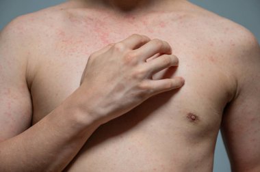 Dermatitis rash viral disease with immunodeficiency on body of young adult asian, scratching with itching, Measles Virus, Viral Exanthem