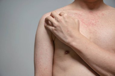 Dermatitis rash viral disease with immunodeficiency on body of young adult asian, scratching with itching, Measles Virus, Viral Exanthem