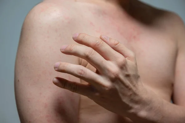Dermatitis Rash Viral Disease Immunodeficiency Body Young Adult Asian Scratching — Stock Photo, Image