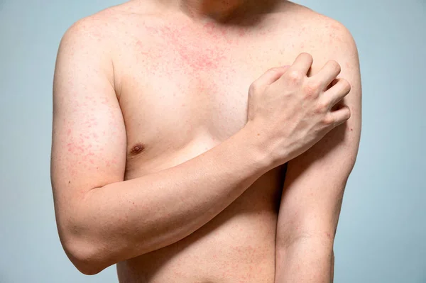 Dermatitis Rash Viral Disease Immunodeficiency Body Young Adult Asian Scratching — Fotografia de Stock