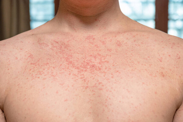 Dermatitis rash viral disease with immunodeficiency on body of young adult asian, scratch with itch, Measles Virus, Viral Exanthem