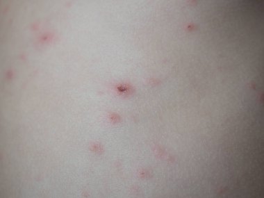 Suçiçeği kaynaklı ülser tedavisi, çocuk cildinde tıbbi krem olan varicella.