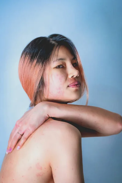 アジアの女性傷上の皮膚アレルギーから化粧品とメークアップ彼女の肌全体のボディ赤かゆく痛みを伴う — ストック写真