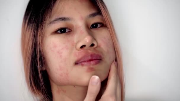 Ασιάτισσα Ξύνει Πρόσωπό Της Από Μολυσμένη Ασθένεια Δερματικής Αλλεργίας Κόκκινο — Αρχείο Βίντεο
