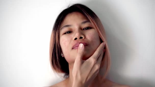 Azjatycka Dziewczyna Alergiczną Skórą Drapie Się Czerwonej Plamie Dłonią Kierunku — Wideo stockowe