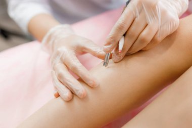 Dermatolog, elektroliz ile hastaların bacakları için tüy dökücü tedavi uyguluyor. Epilasyon ve güzellik kavramı, elektro-epilasyon yapan eller. Kozmetik tıp dolabında çalışan bir doktor..