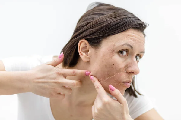 Photo of woman with acne problem squeezing pimple indoors. — Stock Photo, Image