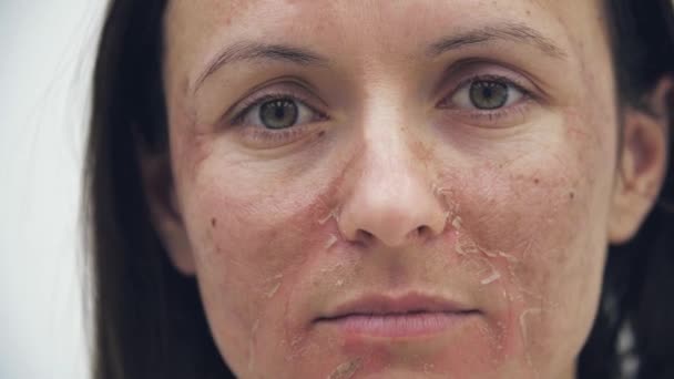 4k video de primer plano de la cara femenina con problemas de piel. — Vídeo de stock