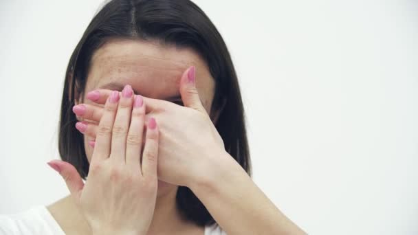 4k slow motion close-видео женщины с кожными проблемами, скрывающей свое лицо. — стоковое видео
