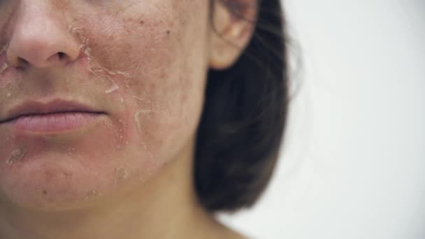 4k beskärd video av kvinna med dålig hud. — Stockvideo