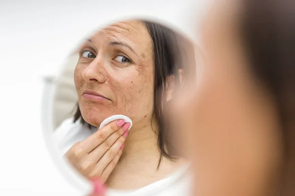 Foto av kvinna som har hudproblem att titta i spegeln. Stockbild