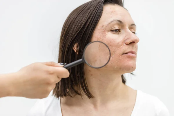 Close up photo of woman with dry skin with magnifying glass. — Stock Photo, Image