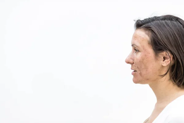 Photo of side view of woman with damaged skin.