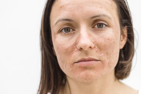 Beskåret foto af kvinde med tør hud over hvid baggrund. Stock-billede