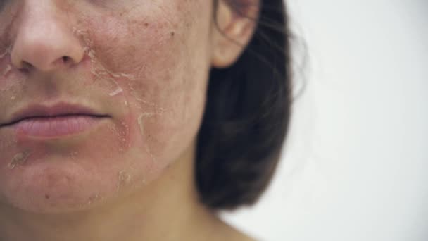 Αργή Κίνηση Βίντεο Της Γυναίκας Κακό Δέρμα Αγγίζοντας Πρόσωπό Της — Αρχείο Βίντεο