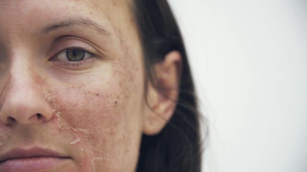 Lassított Felvétel Kivágott Videó Rossz Bőr Bőrápolás Fogalma — Stock videók