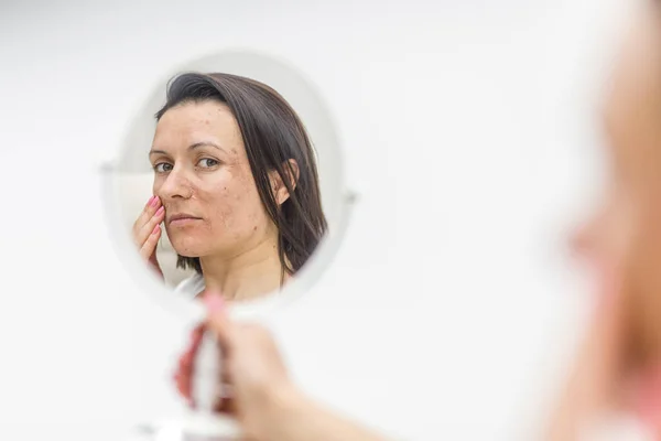 鏡を見ると肌の不具合のある女性の写真 スキンケアの概念 ストック画像