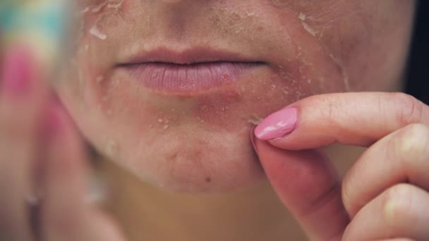 Close Video Van Vrouw Aanraken Van Haar Gezicht Als Huidproblemen — Stockvideo