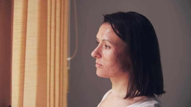 Close Video Van Vrouw Met Huidproblemen Kijken Het Raam Het — Stockvideo
